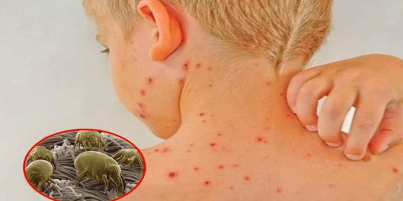 Sv368 Chỉ Cách Diệt Mạt Gà Hiệu Quả Chỉ Trong Một Ngày 4 Mạt gà cắn vào người phải làm thế nào?